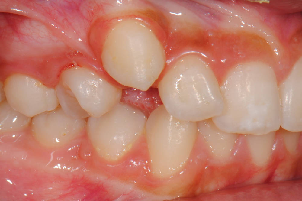 ortodontia-caso1-antes