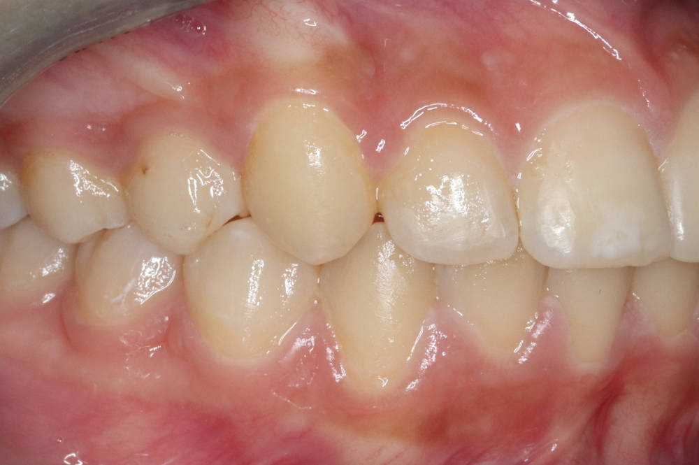 ortodontia-caso1-depois